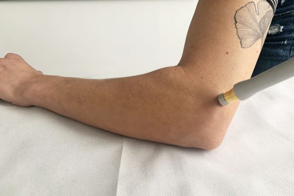 Laserterapia a Vicenza Fisiohome (2)